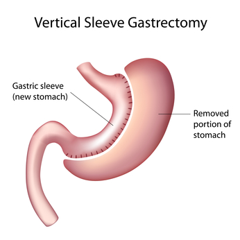 Gastrectomy Sleeve